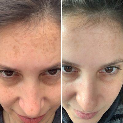 6 month progress of monthly appointments with Staci at Ana Pesce on patches of melasma and uneven skin tone! So pleased with the results :)