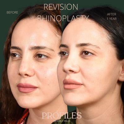 Revision Reconstructive Rhinoplasty