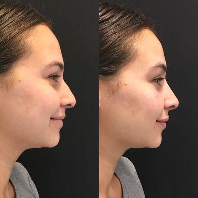 Non-surgical rhinoplasty (liquid nose job) and
Lip augmentation with an injectable Hyaluronic acid filler.
(Juvederm/Restylane product)