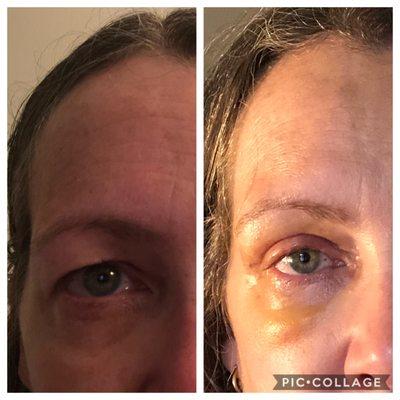 Preop and 1 week post op.  what a difference!