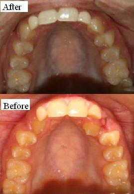 Patient's Before and After pictures