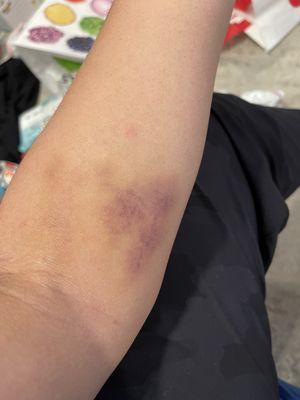 Blood draw was not only painful but was left with this bruise. Stay away from this location. Drive a few miles out.