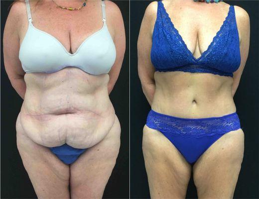 Before and After Tummy Tuck