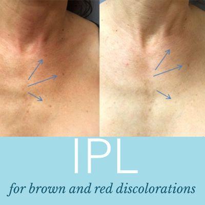 We offer IPL laser to help with red/brown discoloration, our IPL device also offers some skin tightening.