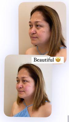 Treated her lateral cheeks and jawline. Beautiful, natural results!