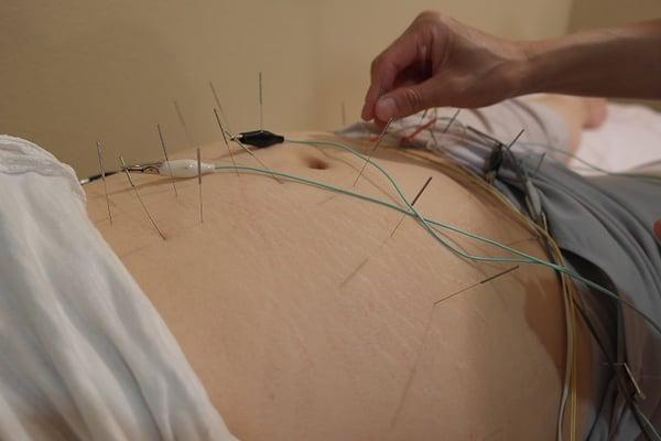 loosing weight needle with electronic stimulate