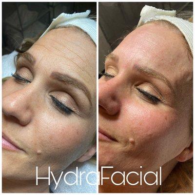 HydraFacial Before and After