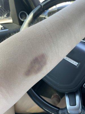 Bruise from a simple blood draw