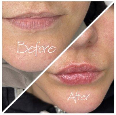 1ML Hyaluronic Acid Lip Filler  Natural Plump, Instant results, No downtime   Non-invasive, needle-less, Pain free