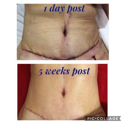 Post lipo and tummy tuck-Top pic 1 day post bottom pic 5 weeks post. Beautiful recovery after 24 sessions of Post Lipo Lymphatic