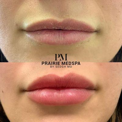 Lip enhancement at Prairie Medical Spa