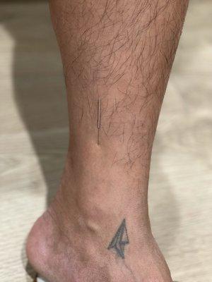 Wrist Ankle acupuncture