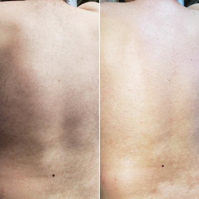 Before & after of a back waxing