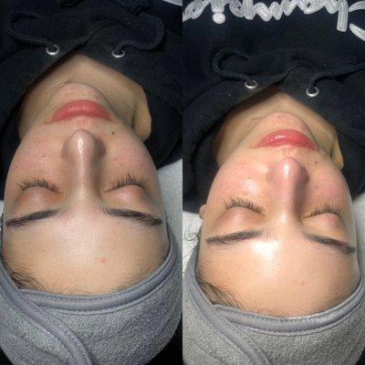 Before&After HydraFacial