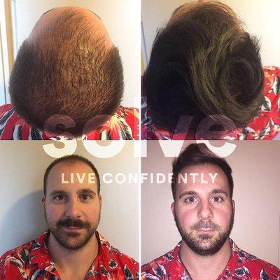 FUE (1700 grafts) + PRP
 
 Solve is the highest rated hair loss clinic in Chicago. Contact us for a free hair loss consultation and price.