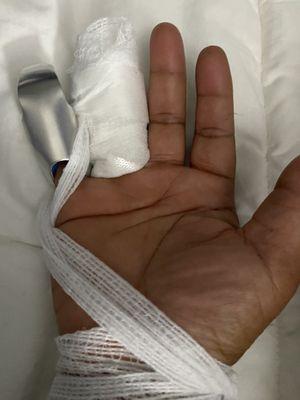 Right hand injury. Picture taken at hospital