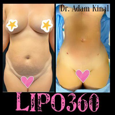 Lipo360Plus