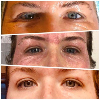 Plasma Lift Fibroblast - upper and lower eyes