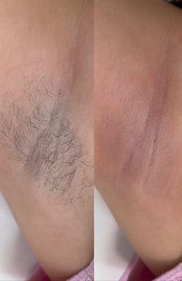 Underarm waxing before and after