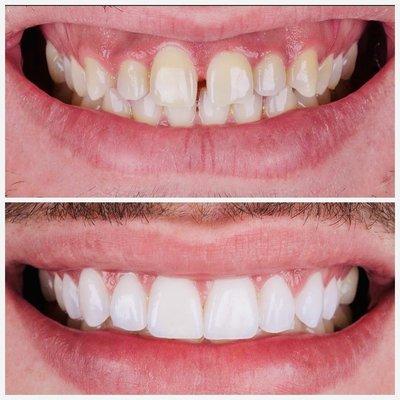 Porcelain veneers for gap closure, color correction and gum contouring