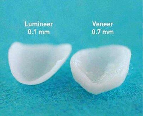 Minimal Preparation veneers to transform a smile quickly.