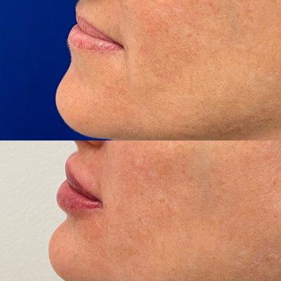 Juvederm volbella