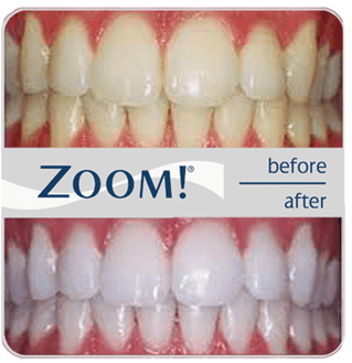 zoom in house whitening