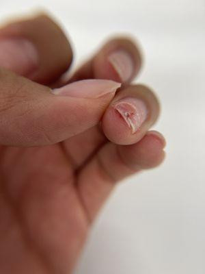 Broken and bleeding nail