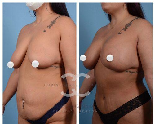 Mommy makeover with tummy tuck, liposuction, breast lift and augmentation!