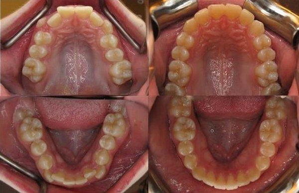 This patient was able to correct her crowding and create a beautiful smile in less than two years using metal braces!