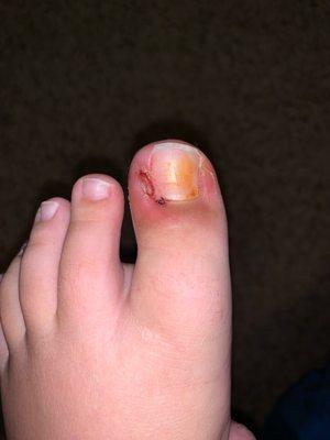 After toe nail removal his toe got infected.