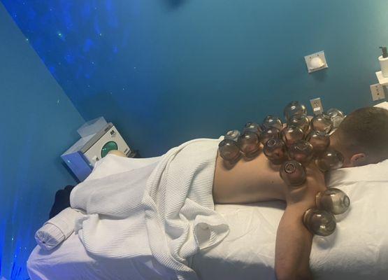 Cupping therapy at cloud 9 for add on $25.