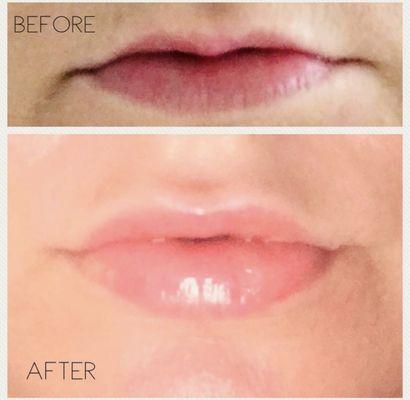 Before and After of Juvaderm Lip Injections