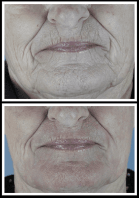 Procedure: Laser Resurfacing 

Actual patient of Dr. Hannah Vargas