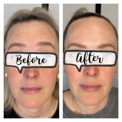 Botox injections before and after, Alexandria VA