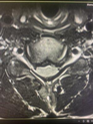 MRI of cervical disc injury