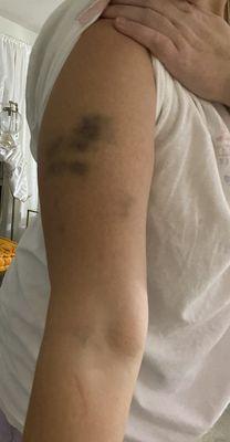 Bruises from Deputy Steven Davis - excessive force