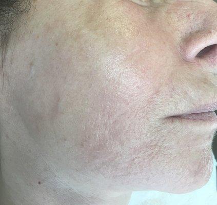 After Chemical Peel