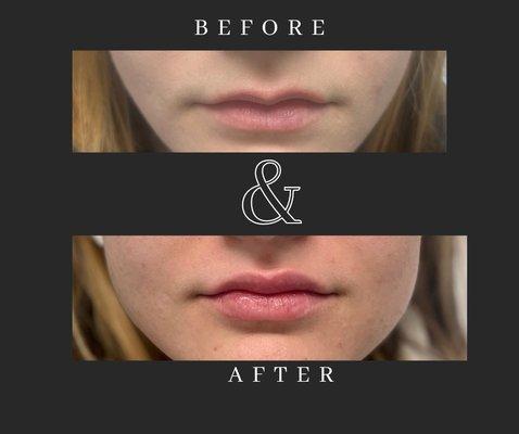 Before and After of Lip Filler! Call and book a appointment today! (406)203.5174