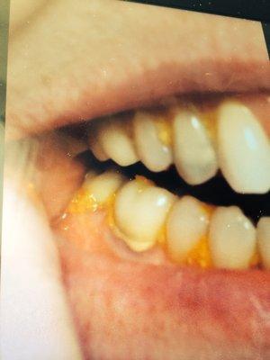 Food jammed between all teeth in spaces created after gums moved after  rough cleaning. Same day as harsh gritty jet solution. Devastated.