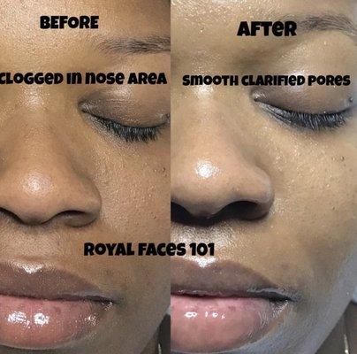 Before & After Royal Facial