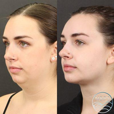 Deep Plane Neck Lift with Fat Grafting to Chin and Jawline