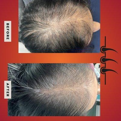 Prp hair restoration