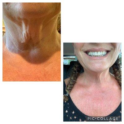 Look at theses results!!! After Only 2 Treatments!