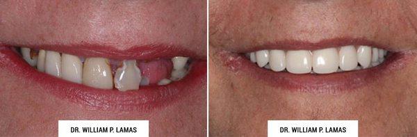 All-on-4 Dental Implants Before & After Photo - William P. Lamas, DMD - Periodontics & Dental Implants...