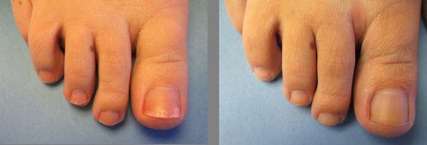 Laser Fungus Before & After 2 treatments.