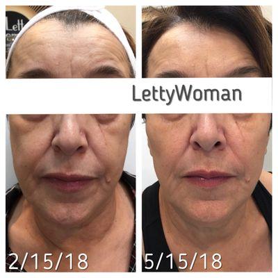 Mid Face Liquid lift plus Dermasweep (think medical grade Hydrafacial).