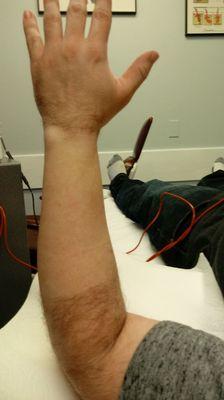 This is an arm that I cleared off with electrolysis for a surgical procedure.