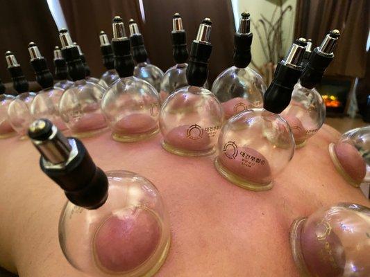 Cupping