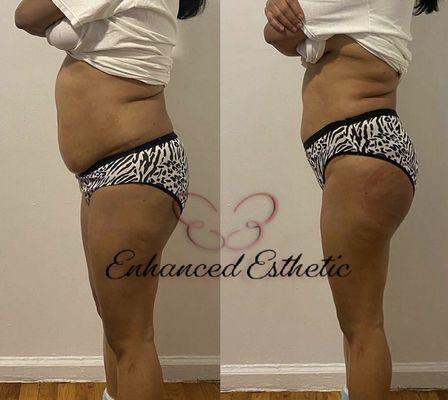 Same day results after Lipo Cavitation on the waist area and Non-Surgical Buttocks lift.